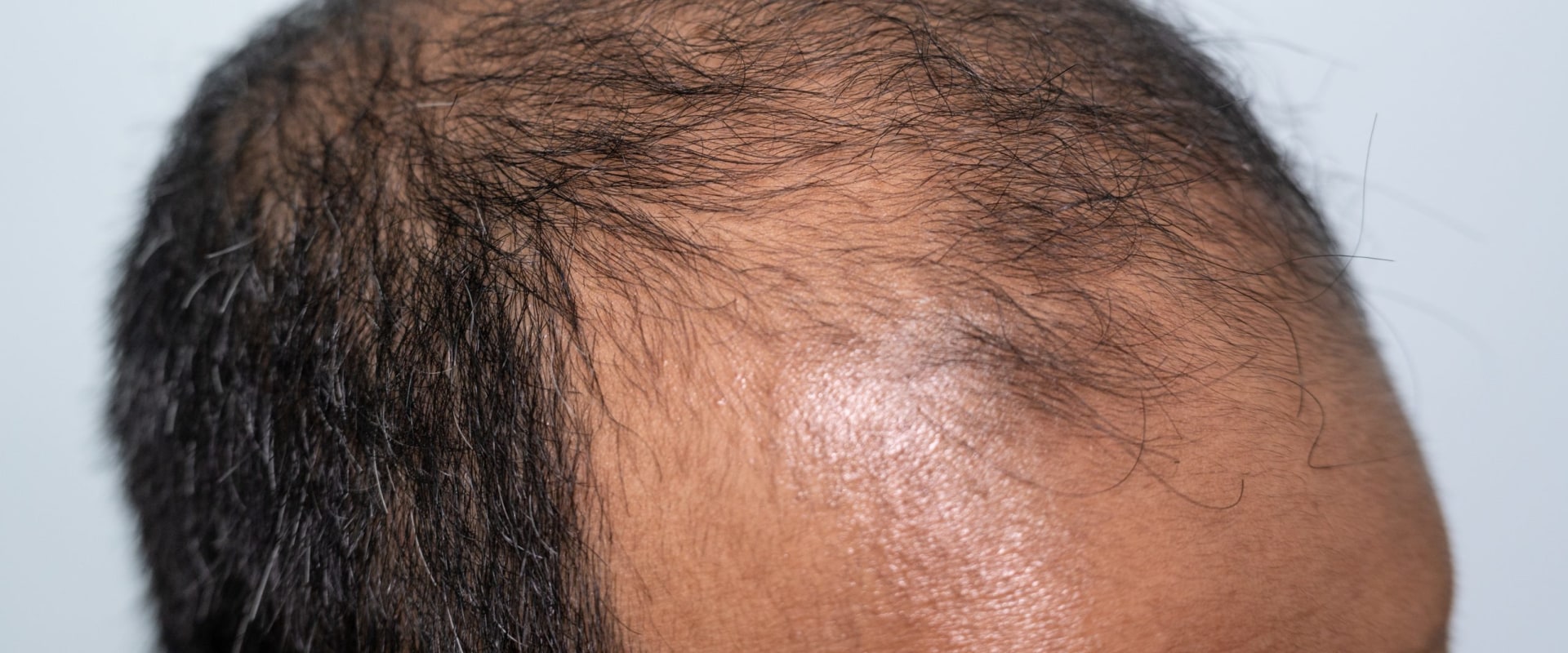 Understanding Hereditary Hair Loss: Causes, Treatments, and Prevention