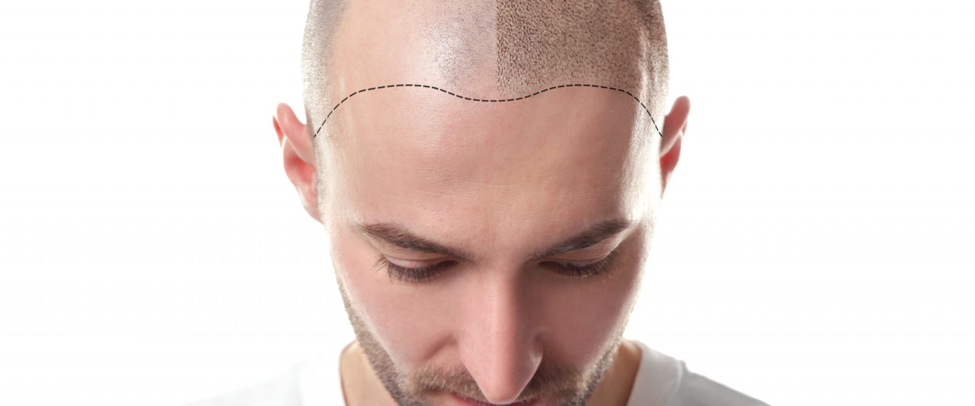 Understanding Scalp Camouflage Techniques