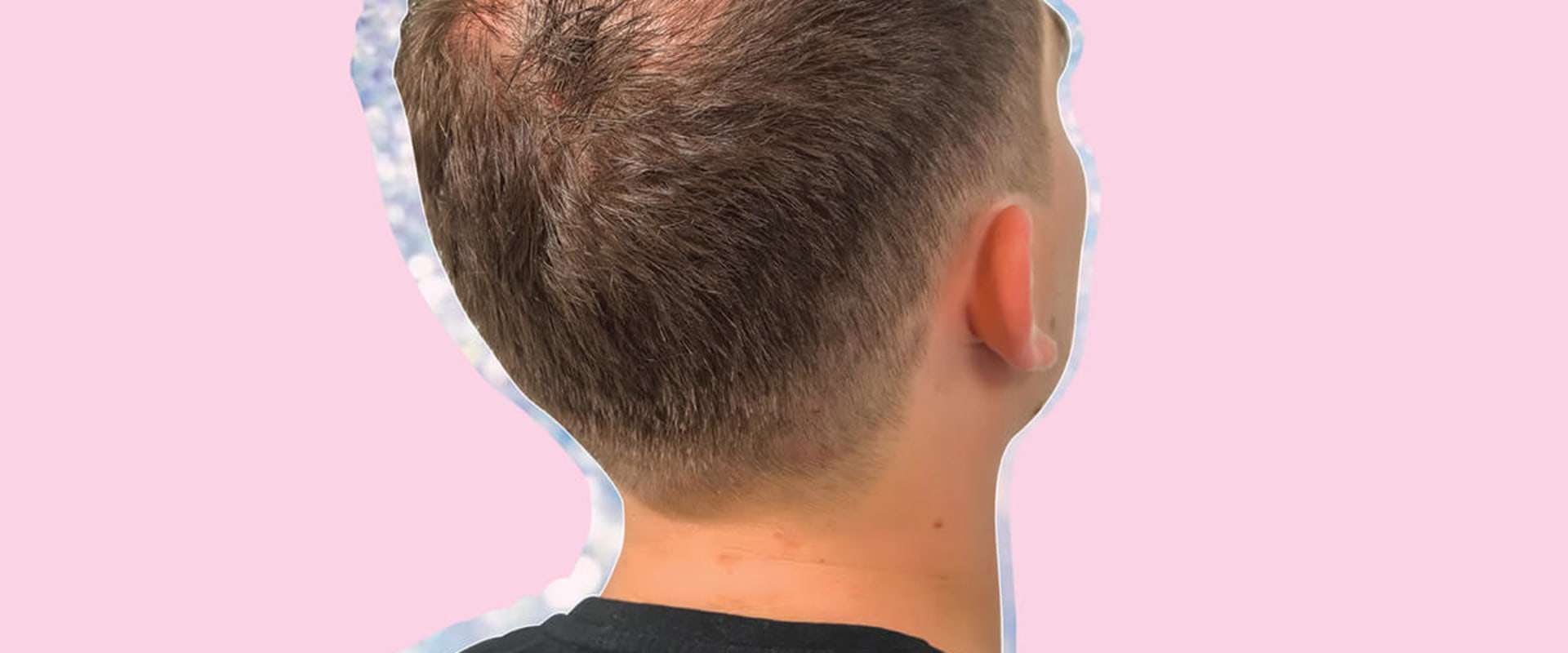 The Truth About Male Pattern Baldness: Causes, Treatments, and Prevention