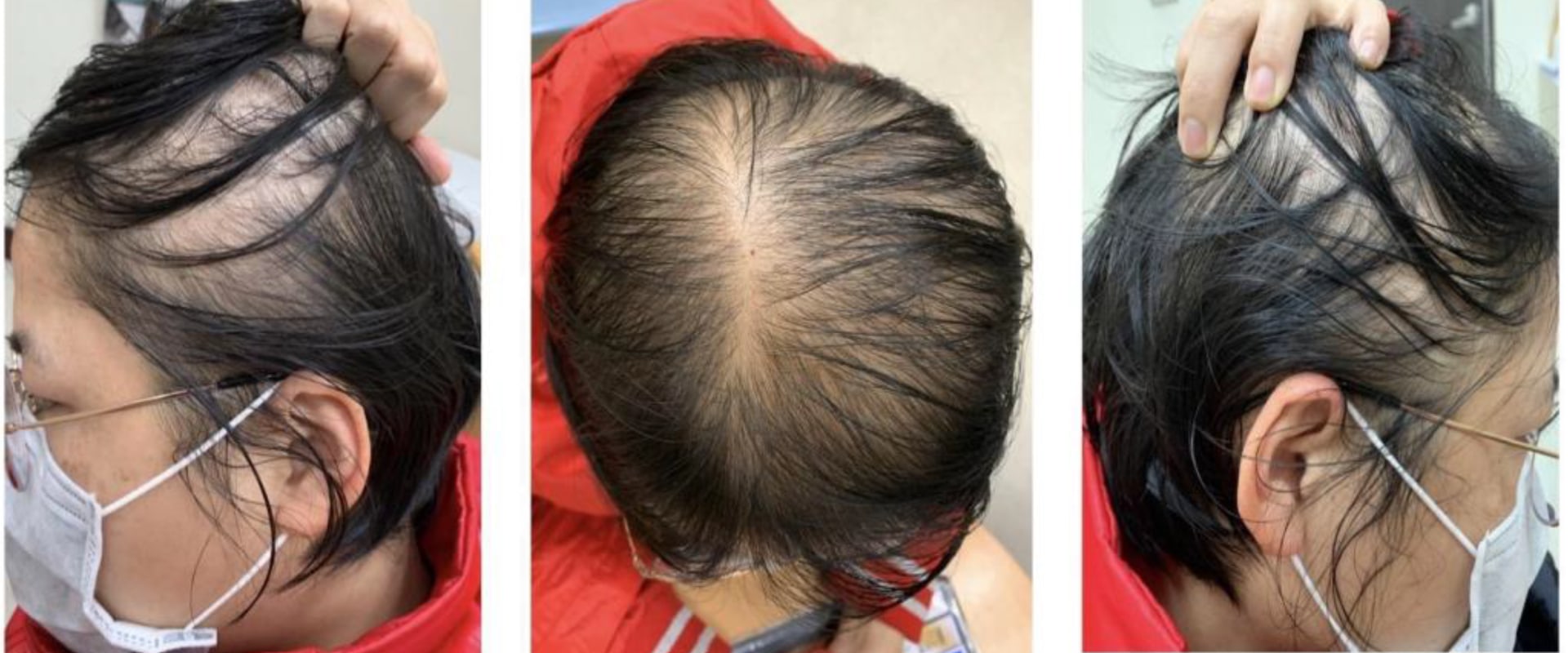 Diagnosing Female Hair Loss: Understanding the Causes and Treatments