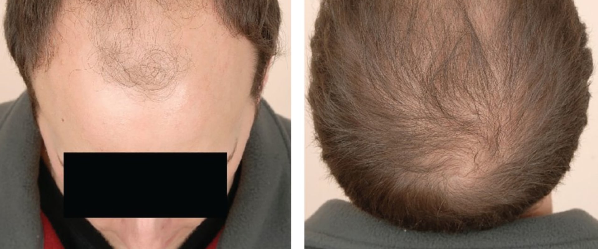 Medical Treatments for Male Pattern Baldness: Everything You Need to Know