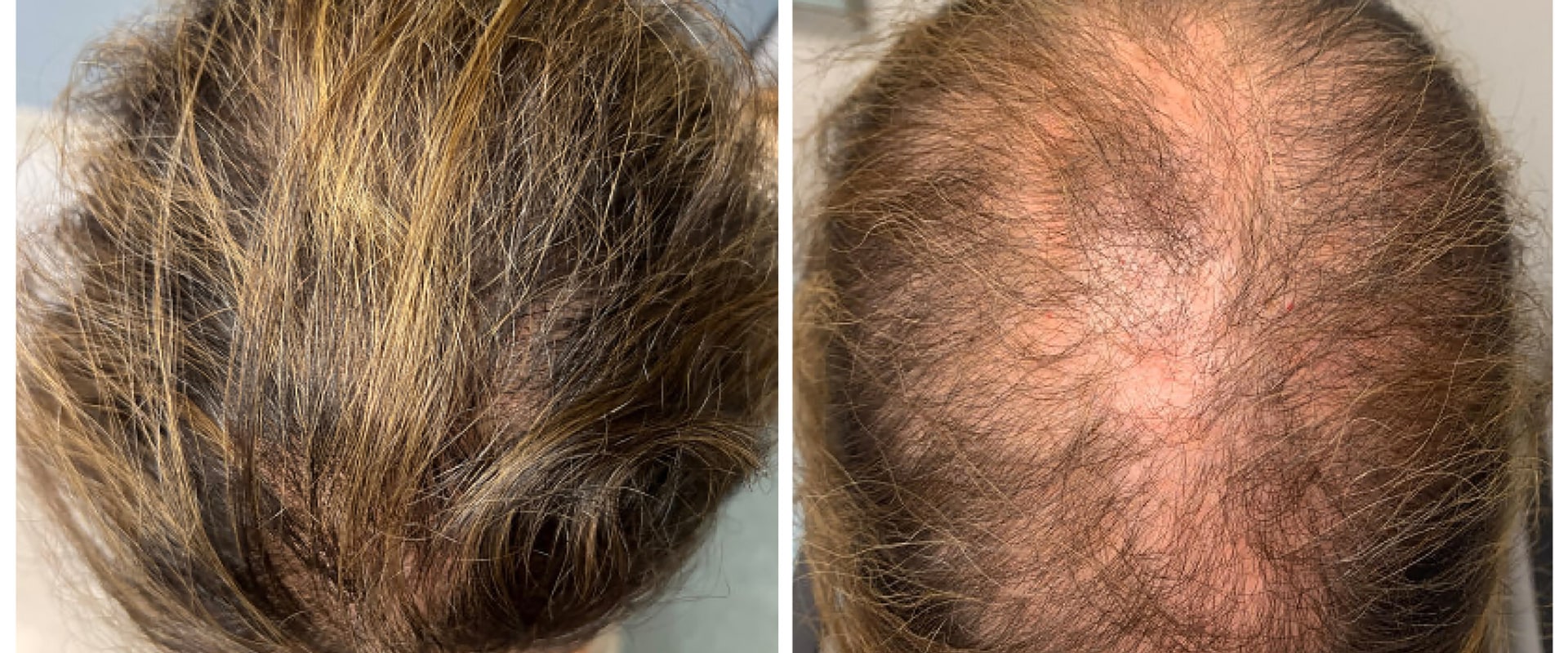 Natural Remedies for Male Pattern Baldness: How to Prevent, Slow Down, and Regrow Hair