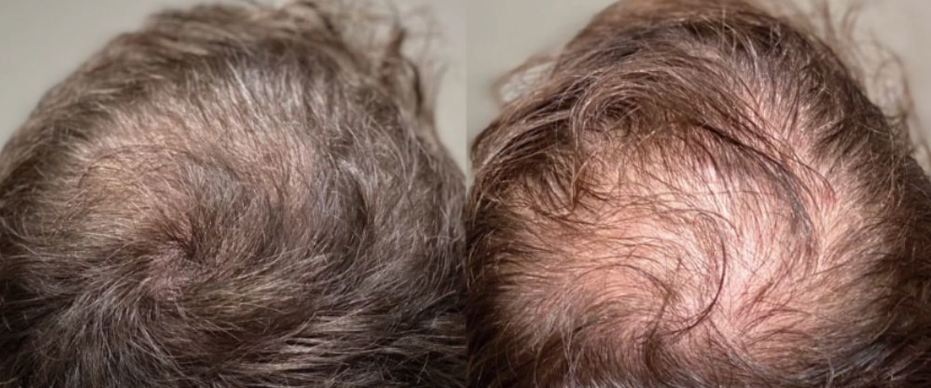 Stress Management for Hair Health: Tips and Techniques for Preventing Baldness and Promoting Regrowth