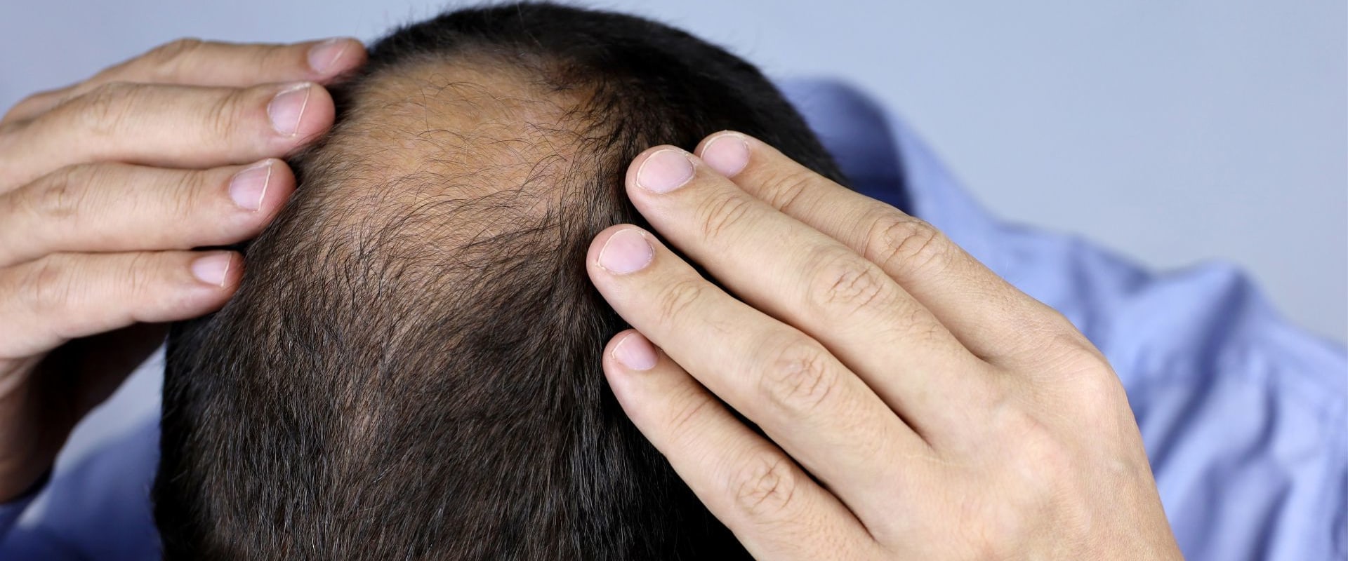 Understanding Minoxidil: A Complete Guide to Hair Loss Treatment