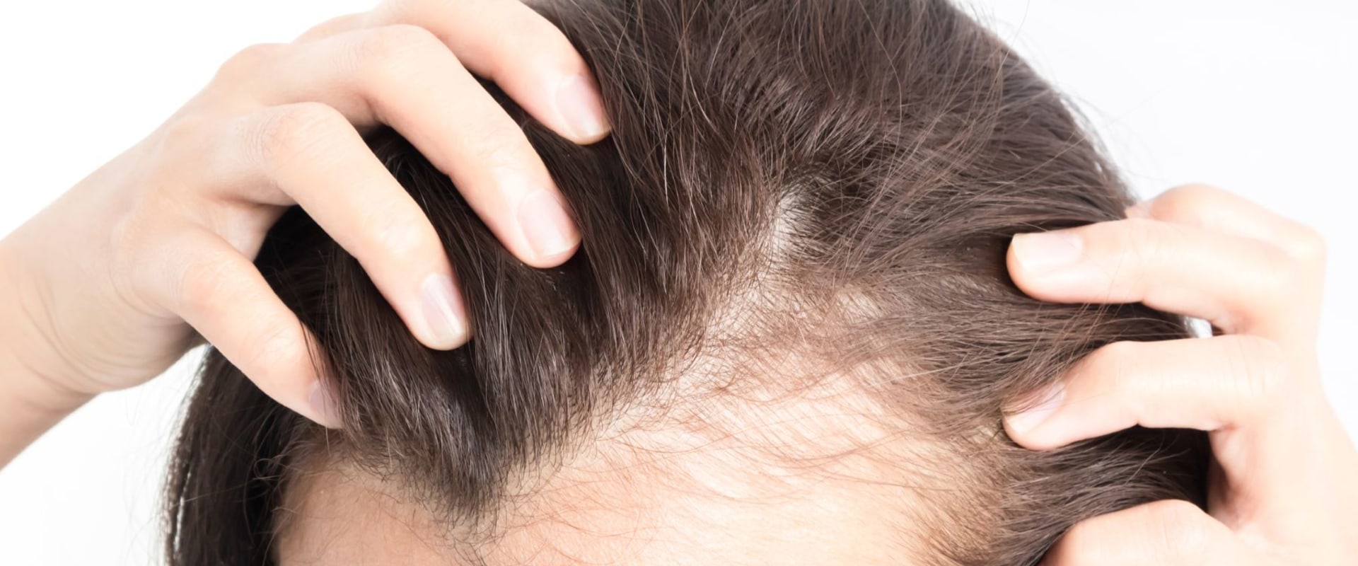 Understanding Hair Loss in Women: Causes, Risks, and Solutions