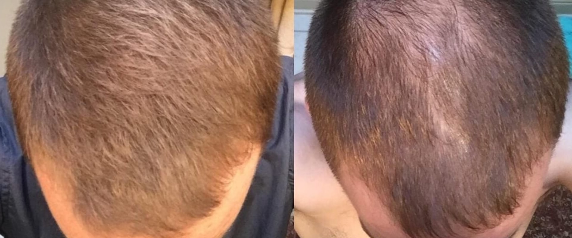 Hair Fibers: The Ultimate Guide for Preventing Baldness and Regrowing Your Hair