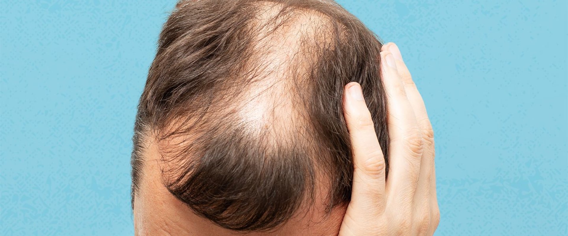 Lifestyle Factors and Male Pattern Baldness: Understanding the Causes and Finding Solutions