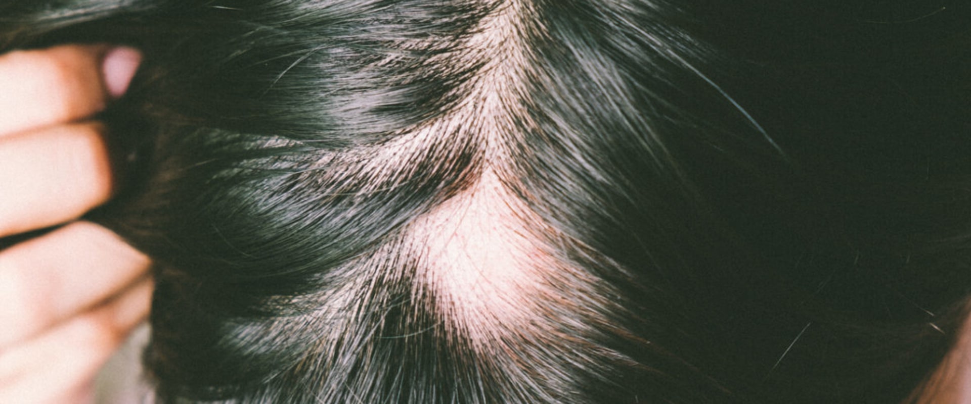 Understanding Alopecia: Causes, Prevention, and Treatment