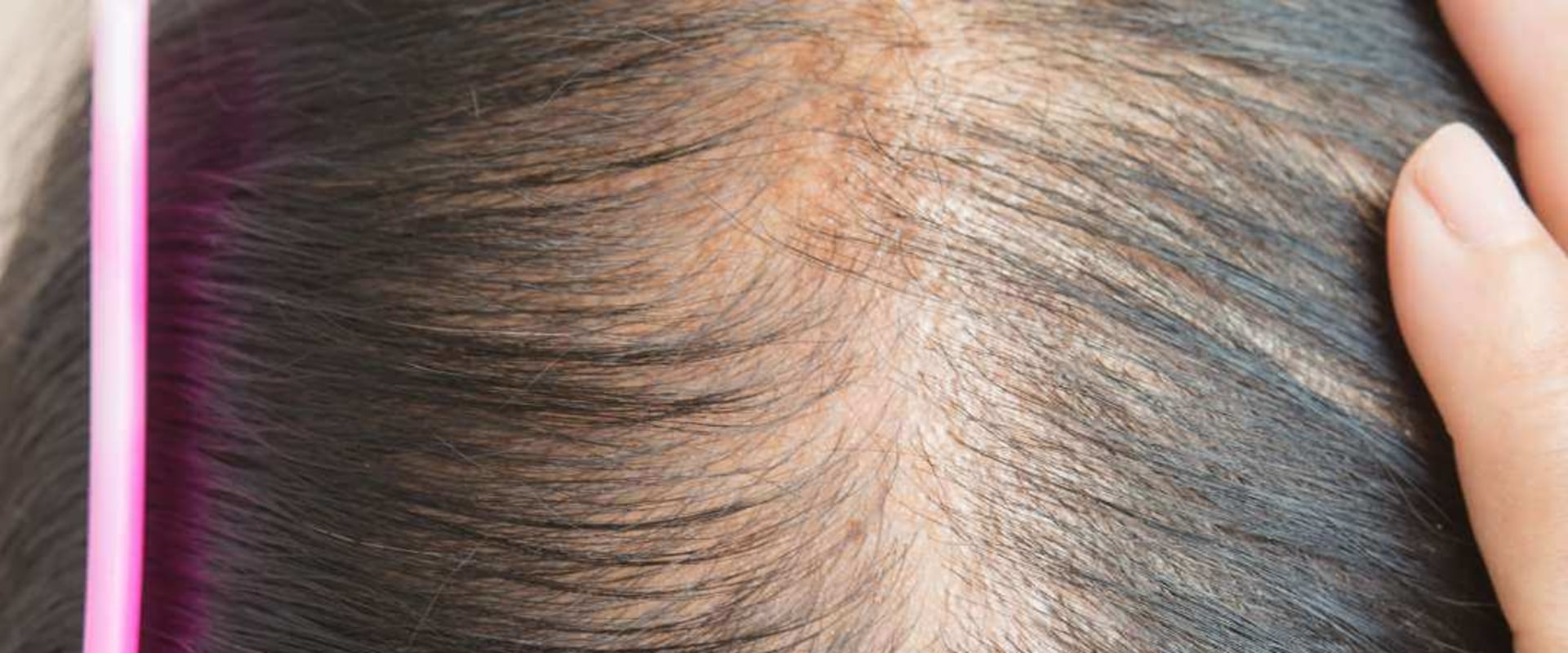 Iron-deficiency Anemia and Hair Loss: Causes, Prevention, and Treatment
