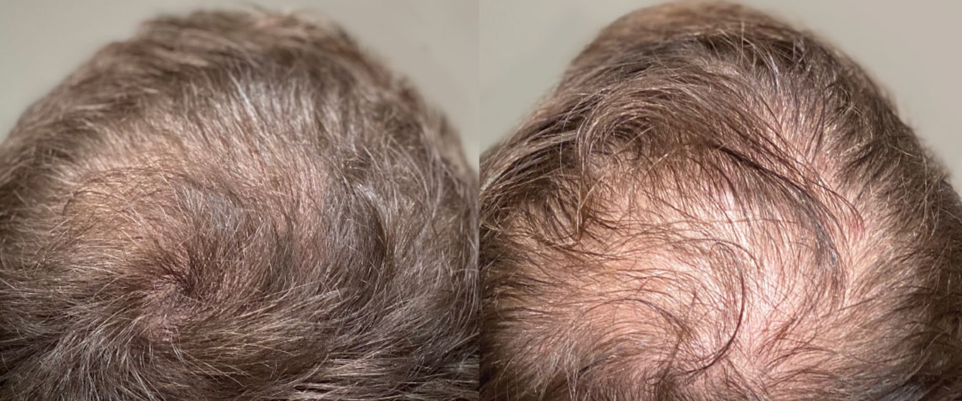 Hair Transplants: The Solution to Preventing and Regrowing Hair Loss