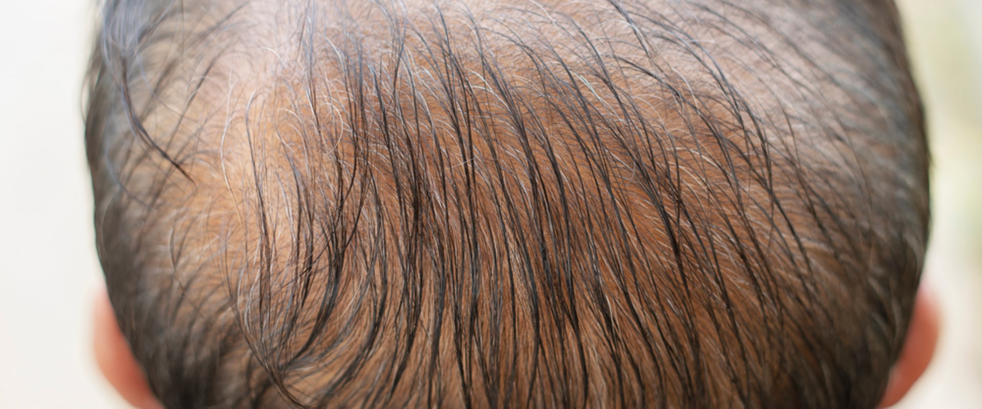 Vitamin C for Hair Health: The Truth About Preventing Baldness and Promoting Regrowth
