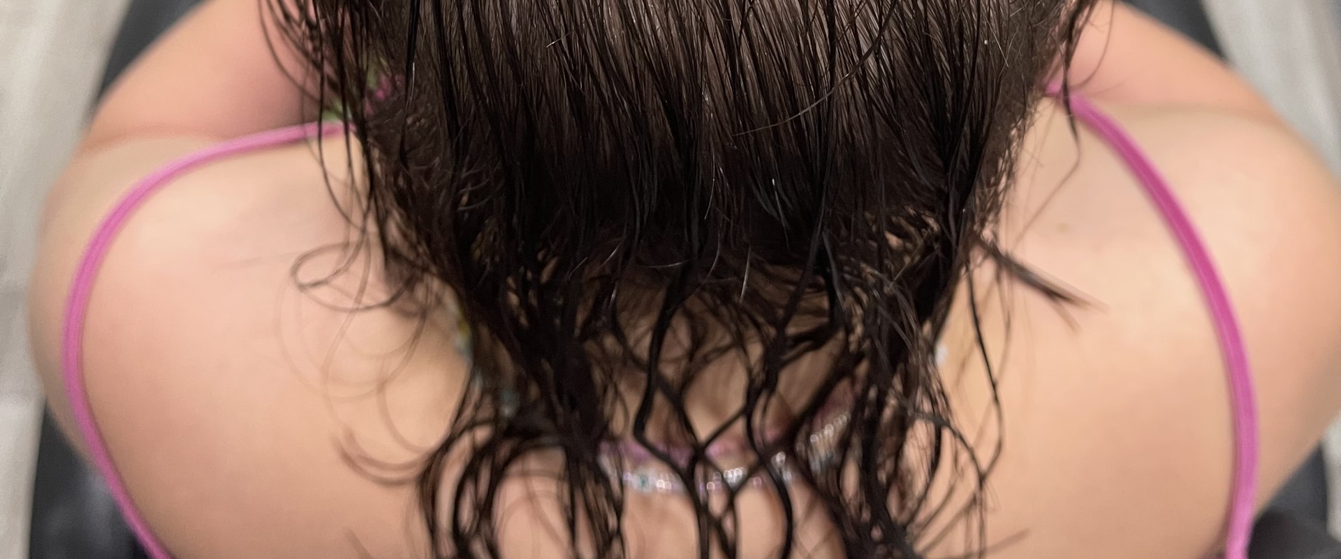 Understanding Female Pattern Hair Loss