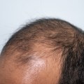 Understanding Hereditary Hair Loss: Causes, Treatments, and Prevention