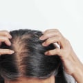 Lifestyle Factors and Female Hair Loss: How to Prevent, Slow Down, and Restore Your Hair