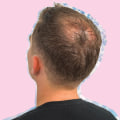 The Truth About Male Pattern Baldness: Causes, Treatments, and Prevention