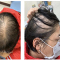Diagnosing Female Hair Loss: Understanding the Causes and Treatments