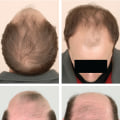 Medical Treatments for Male Pattern Baldness: Everything You Need to Know