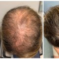 Natural Remedies for Male Pattern Baldness: How to Prevent, Slow Down, and Regrow Hair