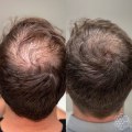 Stress Management for Hair Health: Tips and Techniques for Preventing Baldness and Promoting Regrowth