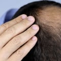 Understanding Minoxidil: A Complete Guide to Hair Loss Treatment