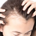 Understanding Hair Loss in Women: Causes, Risks, and Solutions