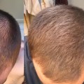 Hair Fibers: The Ultimate Guide for Preventing Baldness and Regrowing Your Hair