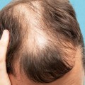 Lifestyle Factors and Male Pattern Baldness: Understanding the Causes and Finding Solutions
