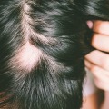 Understanding Alopecia: Causes, Prevention, and Treatment
