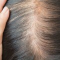 Iron-deficiency Anemia and Hair Loss: Causes, Prevention, and Treatment