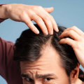 Understanding Finasteride: Preventing Baldness and Restoring Hair Growth