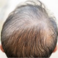Vitamin C for Hair Health: The Truth About Preventing Baldness and Promoting Regrowth