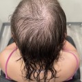Understanding Female Pattern Hair Loss