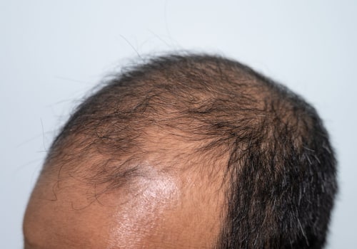 Understanding Hereditary Hair Loss: Causes, Treatments, and Prevention