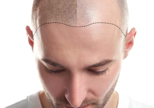 Understanding Scalp Camouflage Techniques