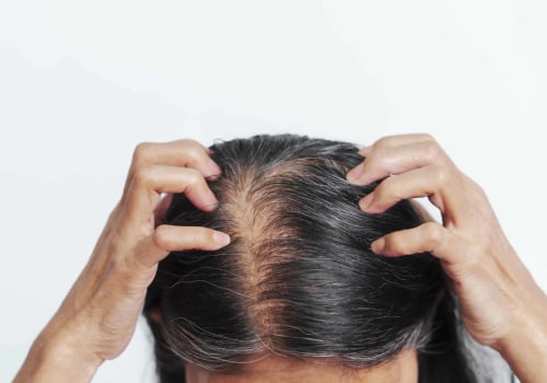 Lifestyle Factors and Female Hair Loss: How to Prevent, Slow Down, and Restore Your Hair