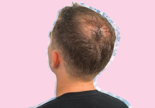 The Truth About Male Pattern Baldness: Causes, Treatments, and Prevention