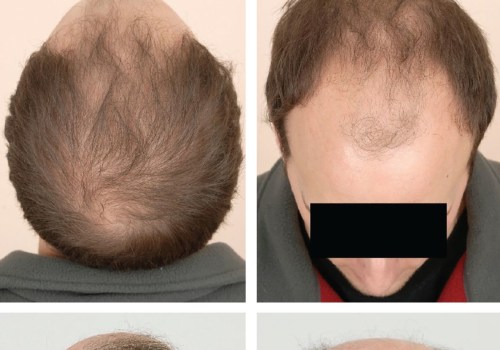 Medical Treatments for Male Pattern Baldness: Everything You Need to Know