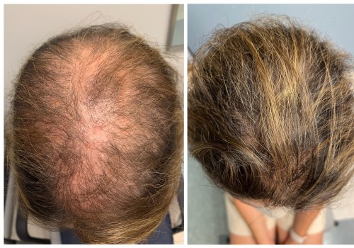 Natural Remedies for Male Pattern Baldness: How to Prevent, Slow Down, and Regrow Hair