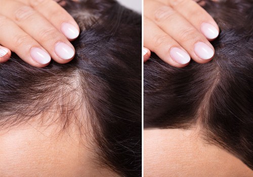 Hair Thickening Sprays: The Ultimate Guide to Preventing Baldness and Promoting Hair Growth