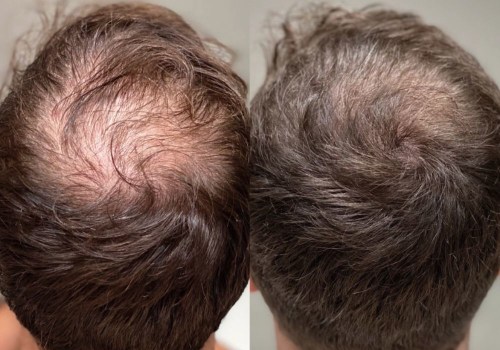 Poor Diet and Hair Loss: How to Prevent and Treat Hair Loss