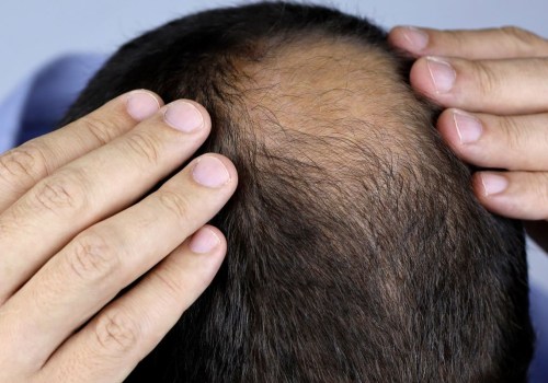 Understanding Minoxidil: A Complete Guide to Hair Loss Treatment