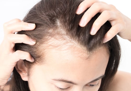 Understanding Hair Loss in Women: Causes, Risks, and Solutions