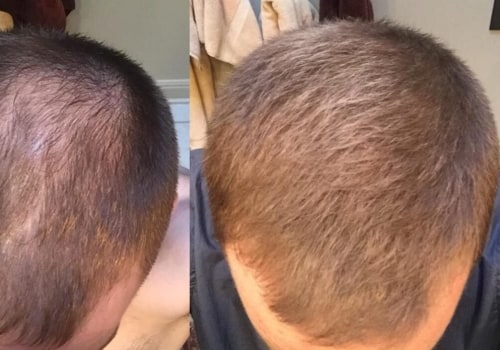 Hair Fibers: The Ultimate Guide for Preventing Baldness and Regrowing Your Hair