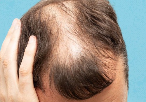 Lifestyle Factors and Male Pattern Baldness: Understanding the Causes and Finding Solutions