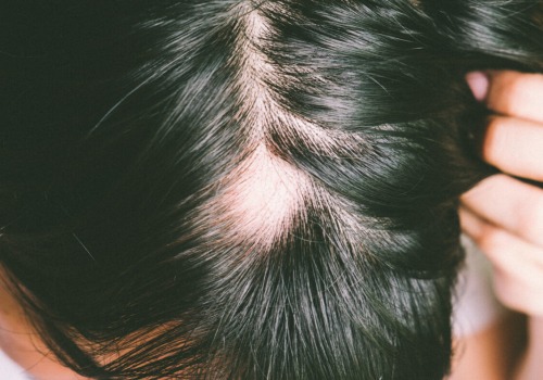 Understanding Alopecia: Causes, Prevention, and Treatment