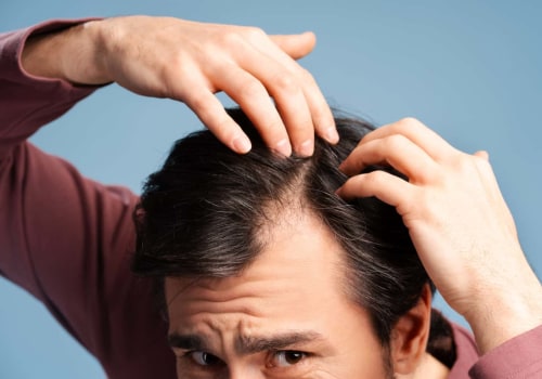 Understanding Finasteride: Preventing Baldness and Restoring Hair Growth