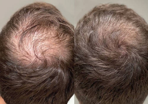 Hair Transplants: The Solution to Preventing and Regrowing Hair Loss