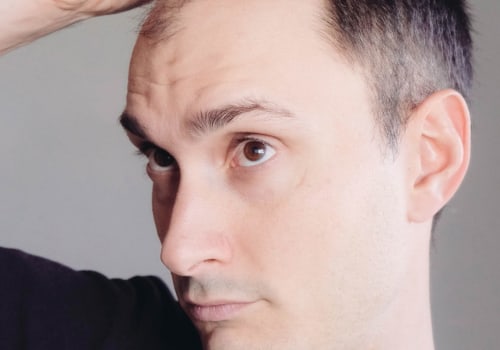 Lifestyle Changes for Preventing Male Pattern Baldness: Expert Tips and Advice
