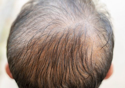 Vitamin C for Hair Health: The Truth About Preventing Baldness and Promoting Regrowth