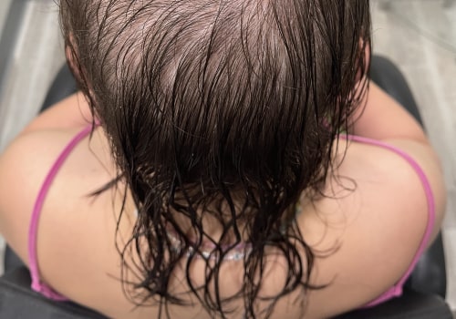 Understanding Female Pattern Hair Loss